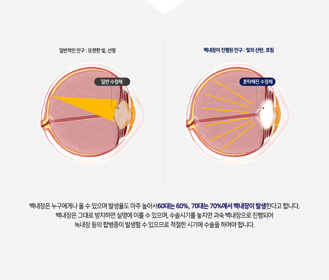 백내장수술