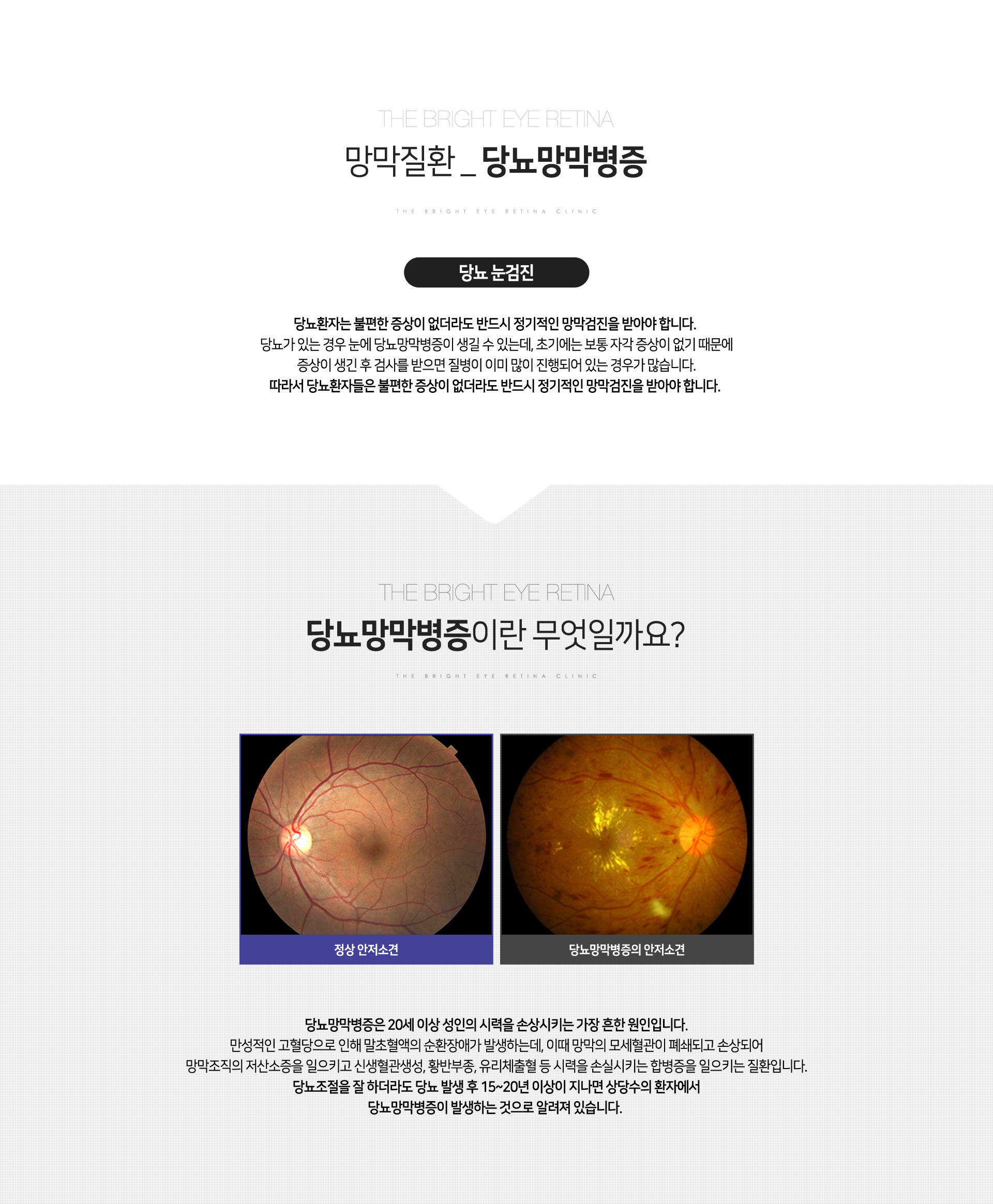 당뇨망막병증