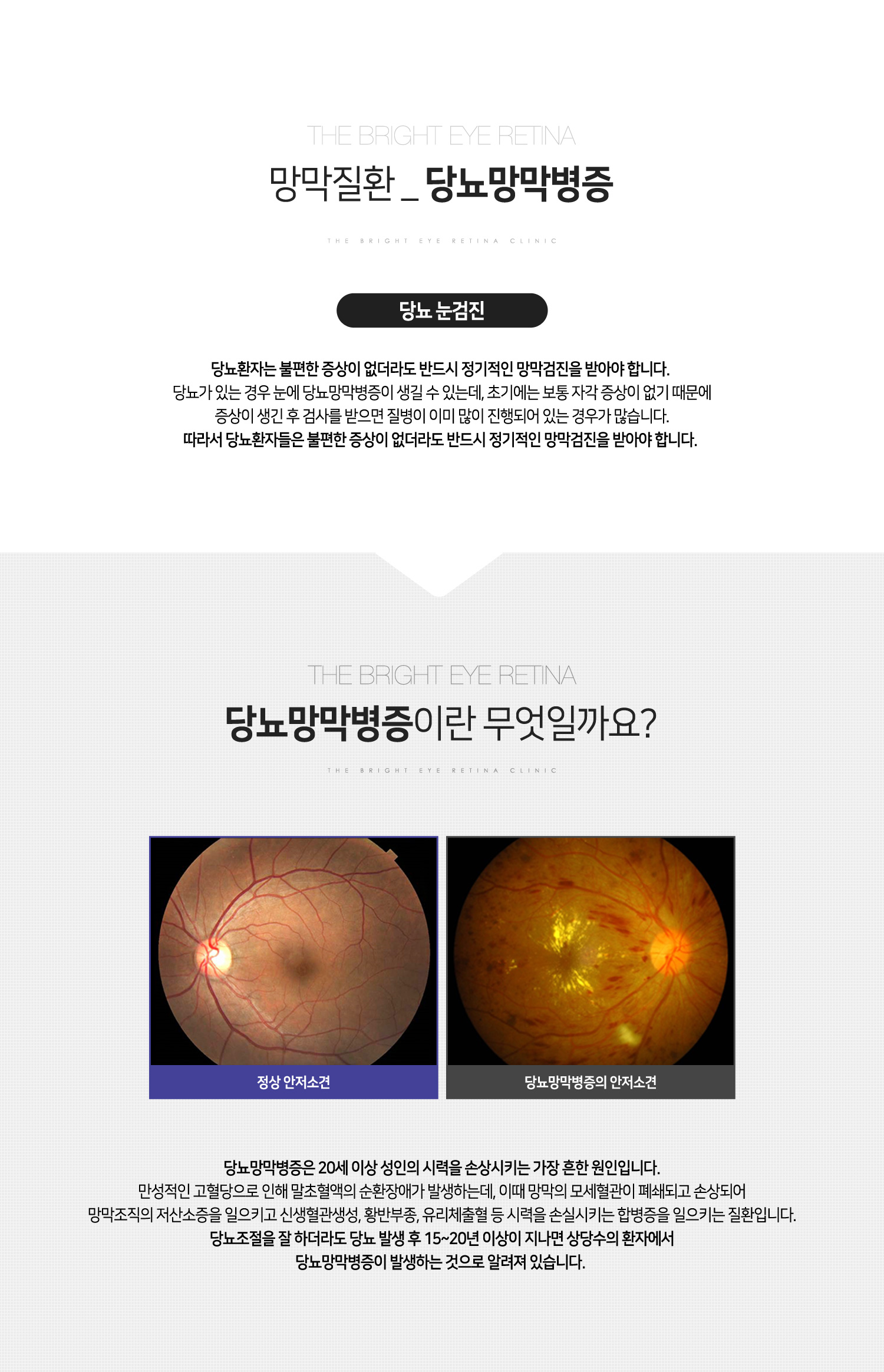 당뇨망막병증