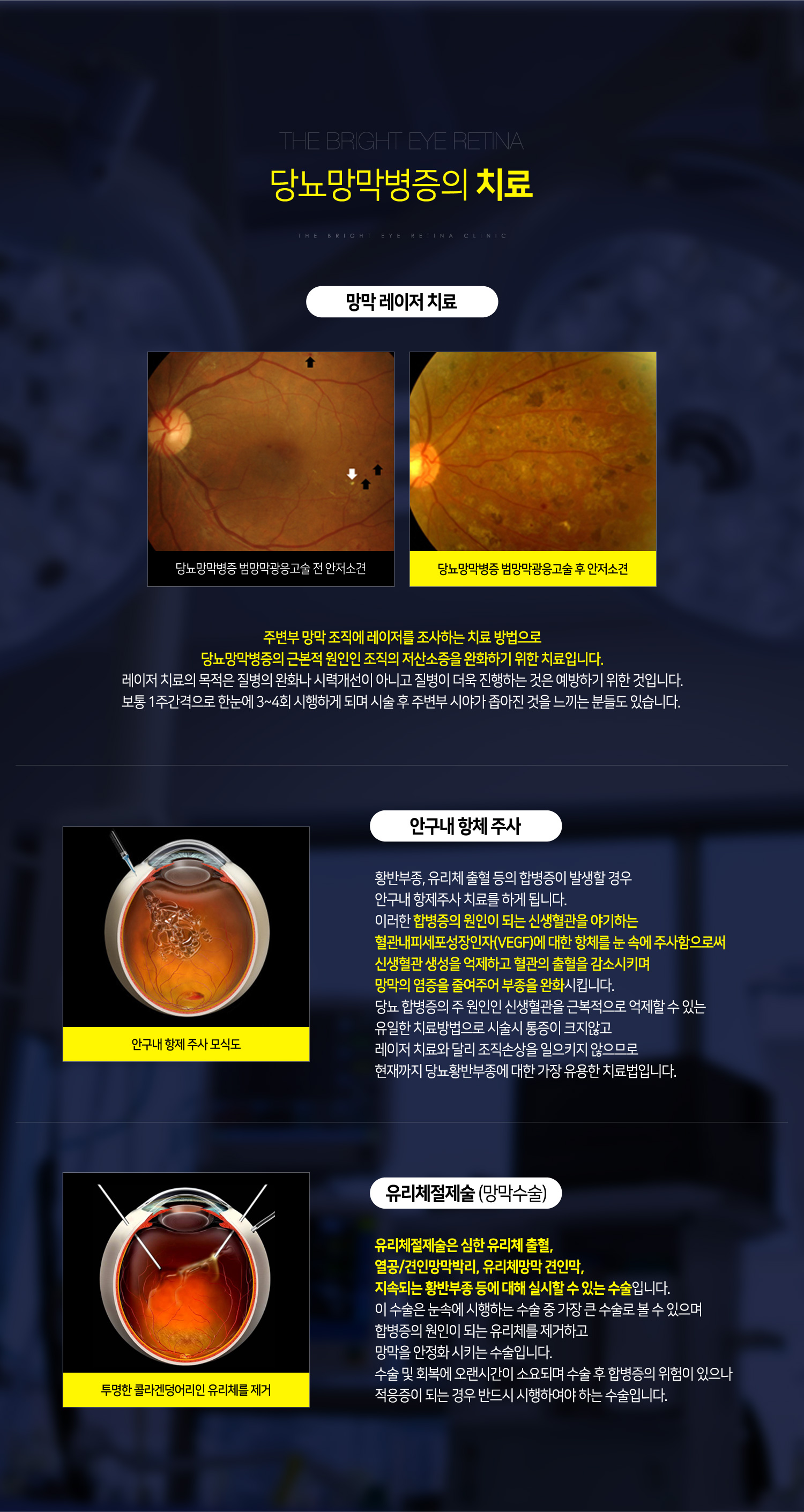 당뇨망막병증