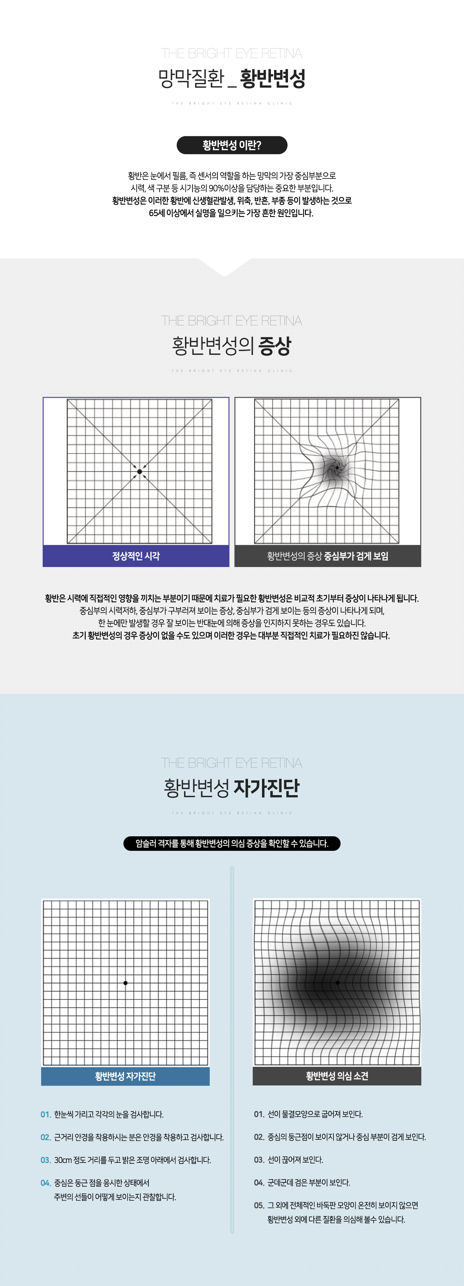 황반변성