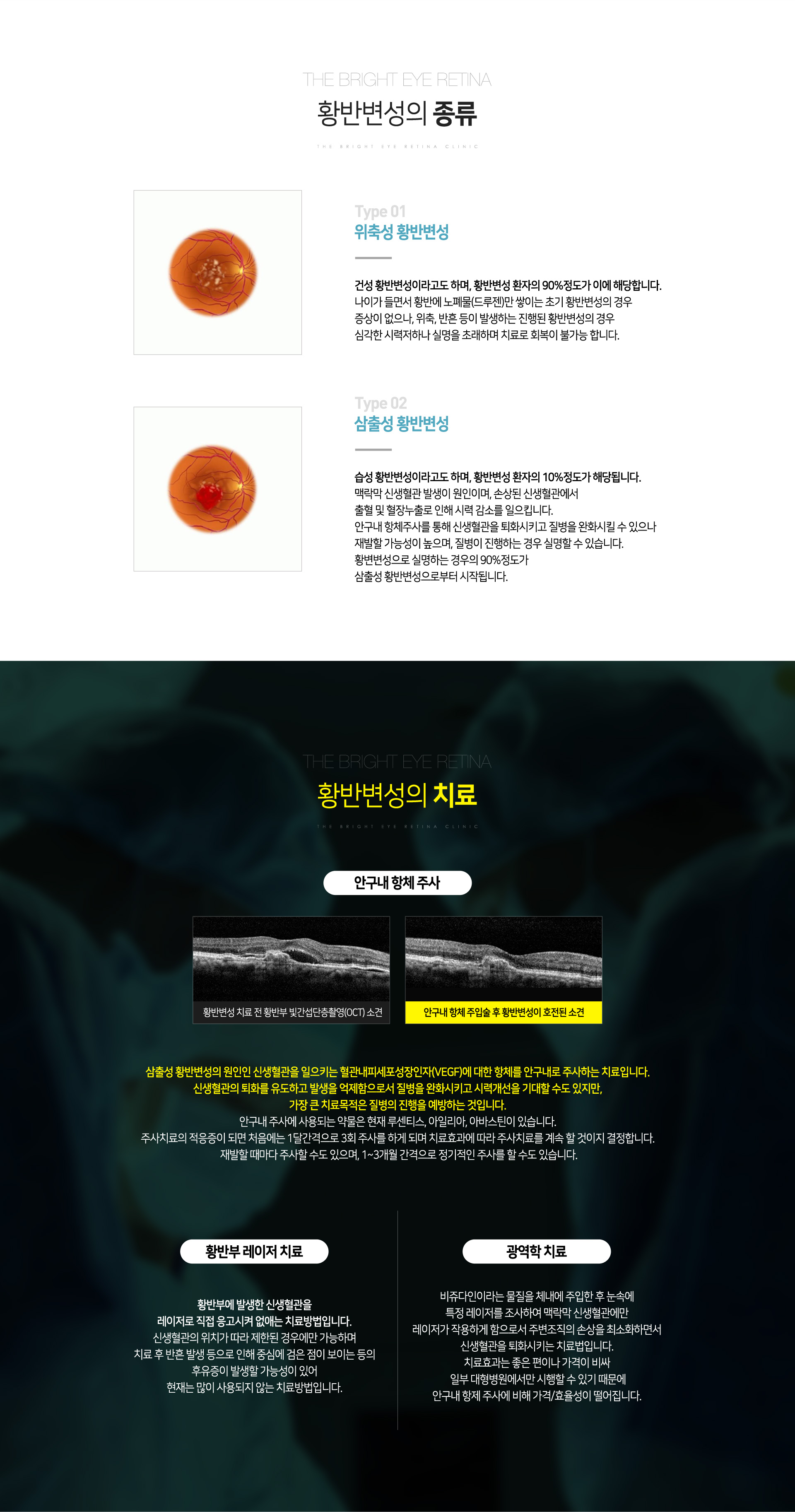 황반변성
