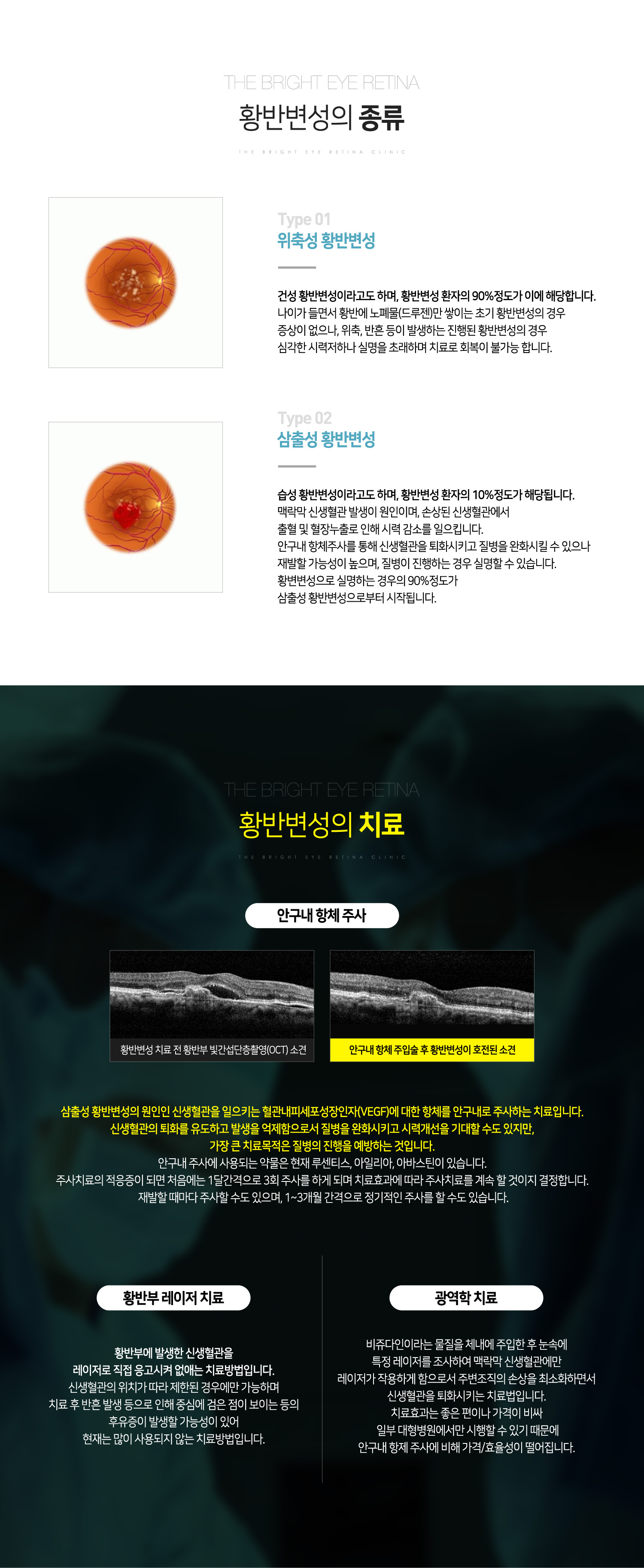 황반변성