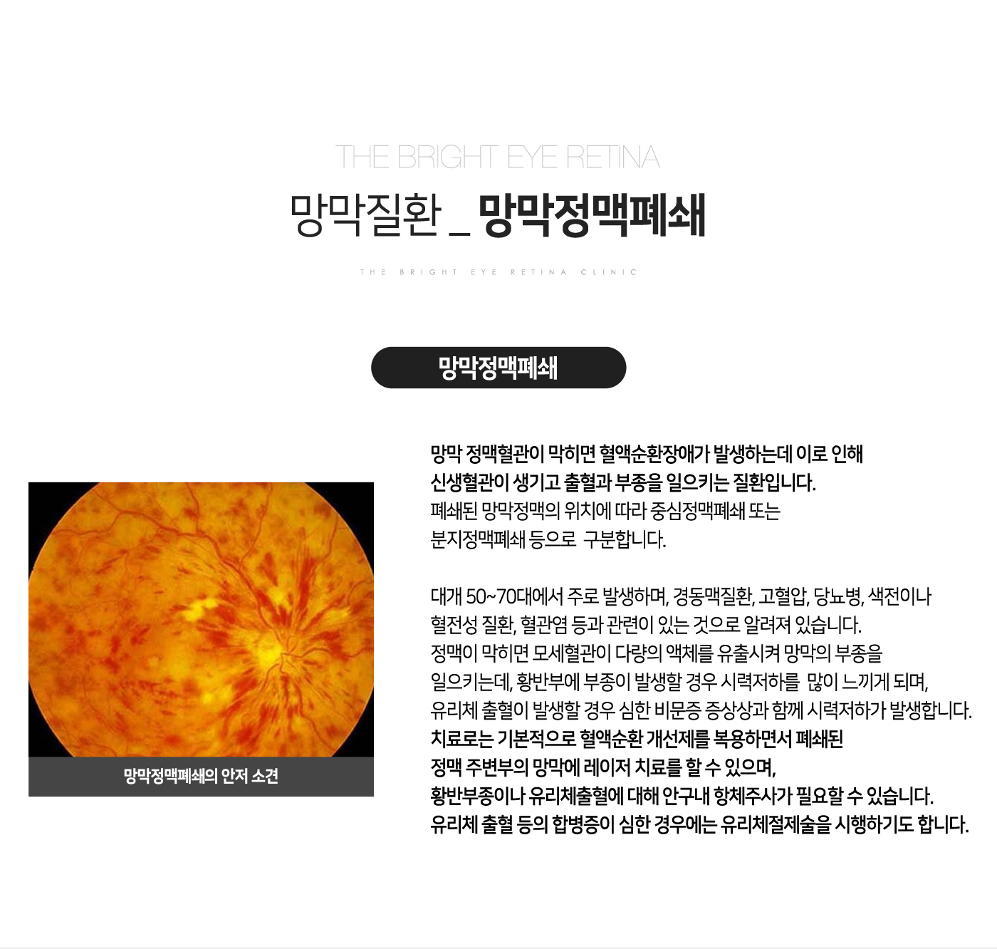 망막정맥폐쇄