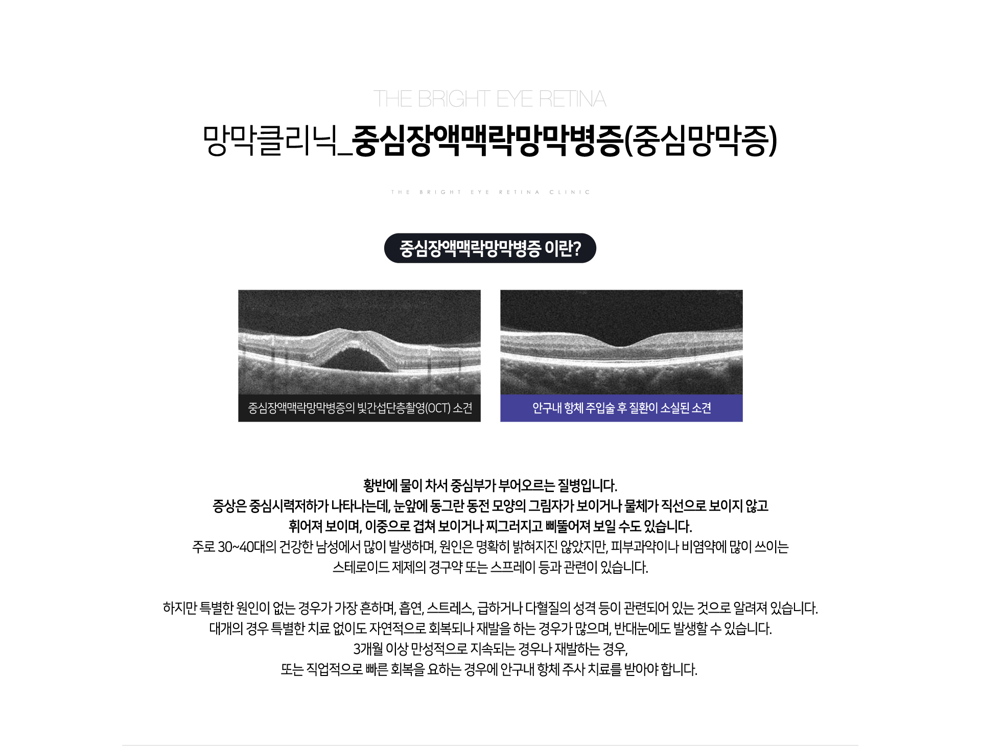 중심장액맥락망막병증(중심망막증)