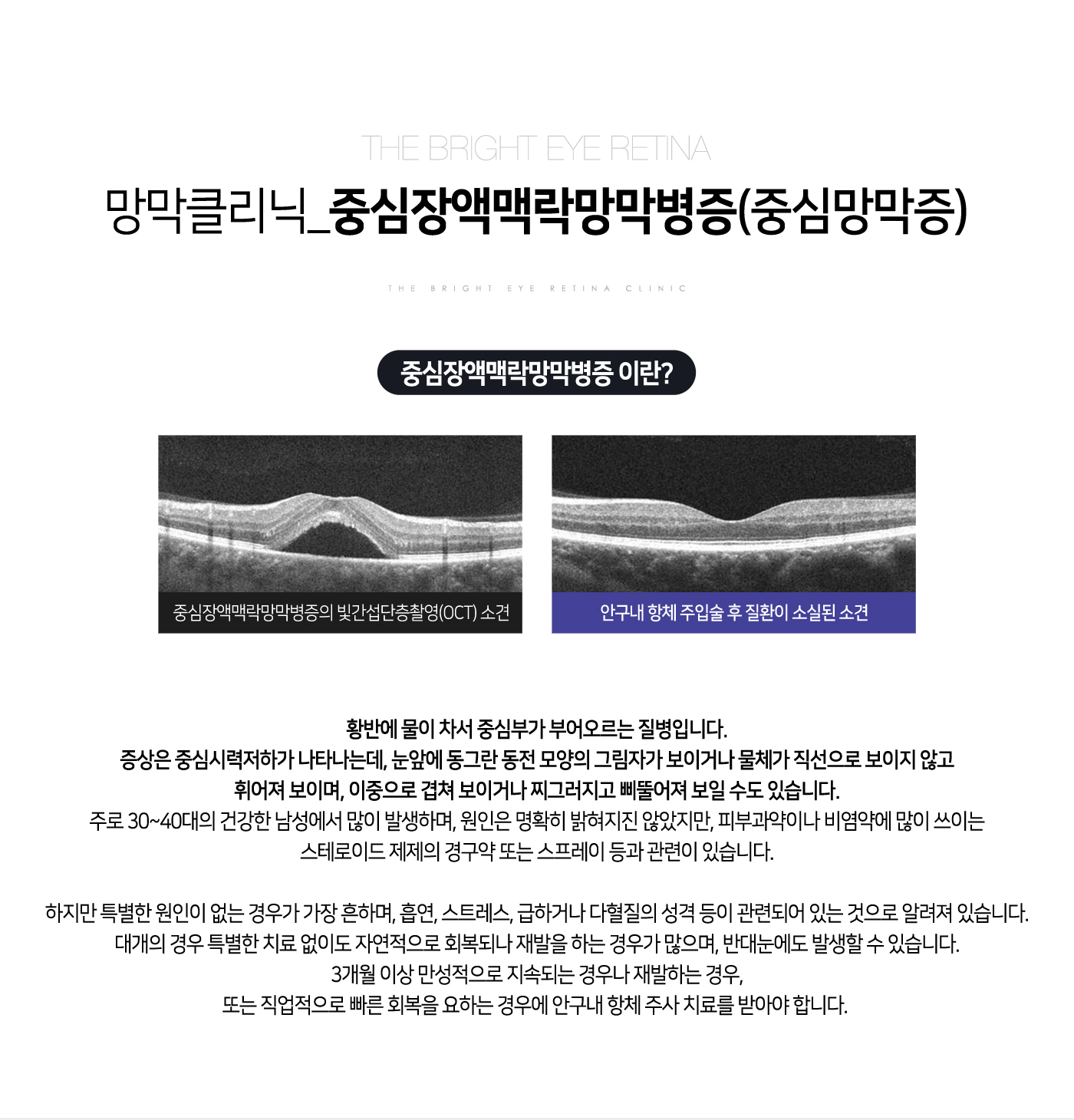 중심장액맥락망막병증(중심망막증)