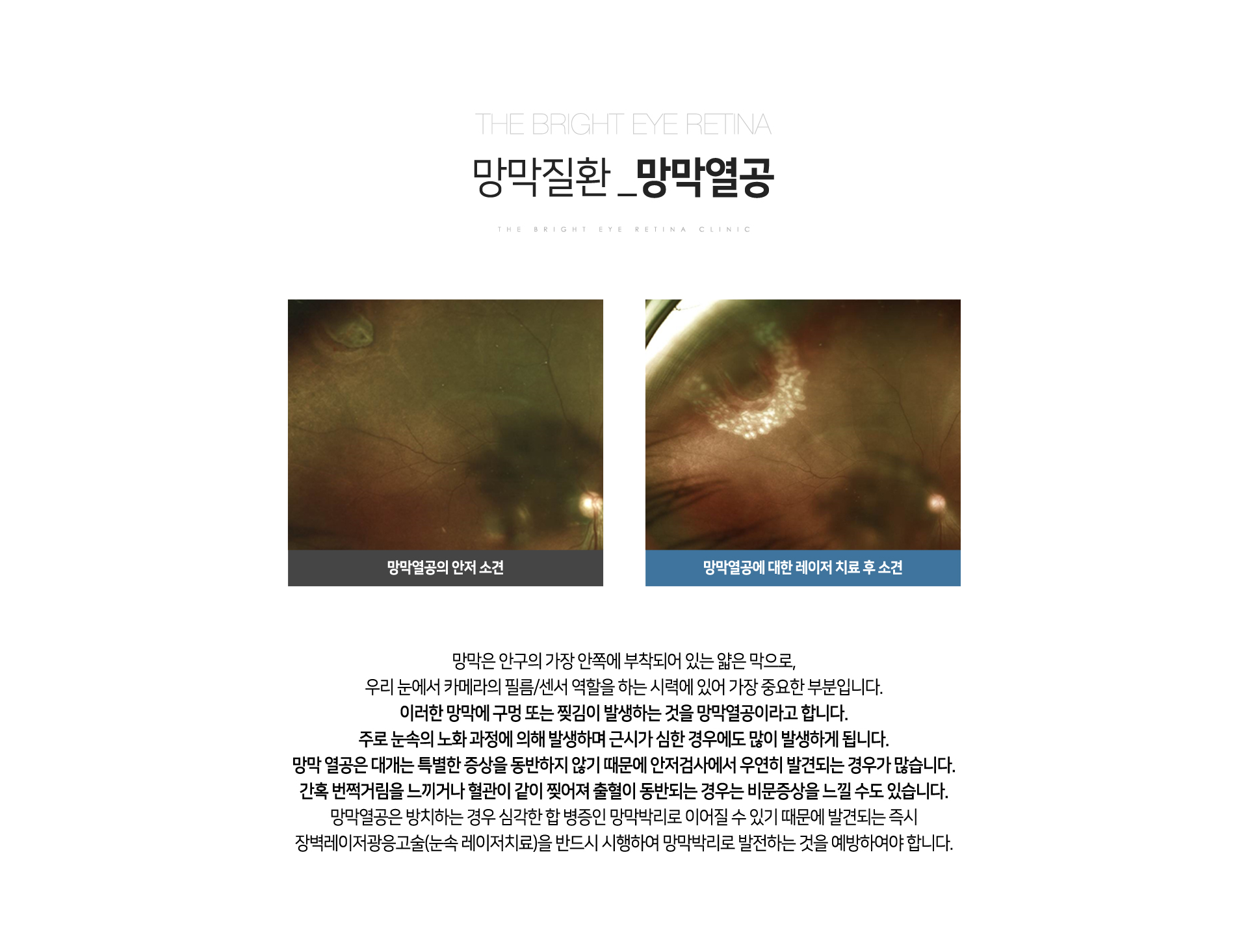 망막열공